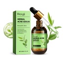 Serum trị mụn kế thừa Hoygi, Giảm mụn trứng cá với kem dưỡng ẩm toàn diện