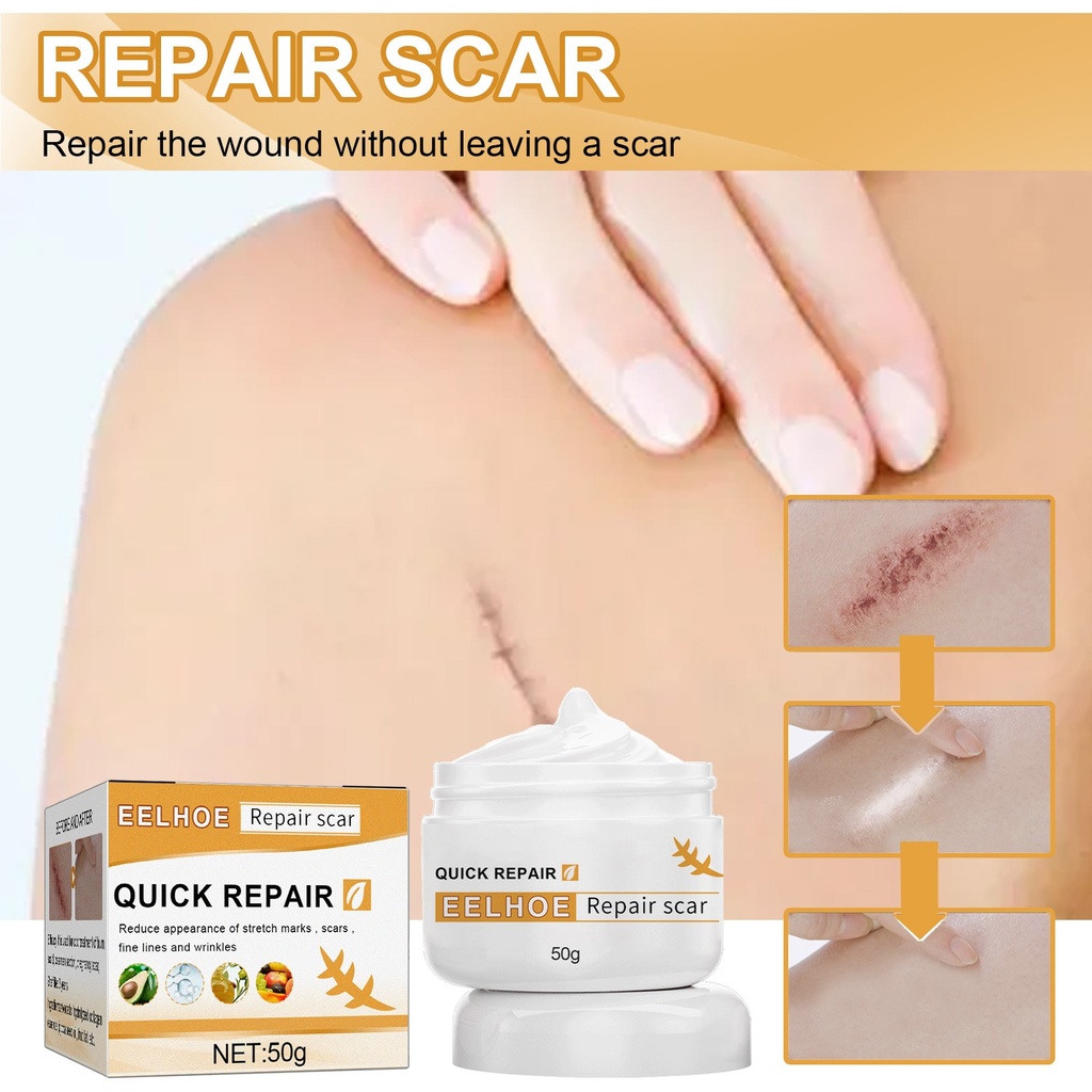 Kem EELHOE Tẩy Mờ Sẹo Da, Kem Sữa Chữa Sẹo Phẫu Thuật Bỏng Da