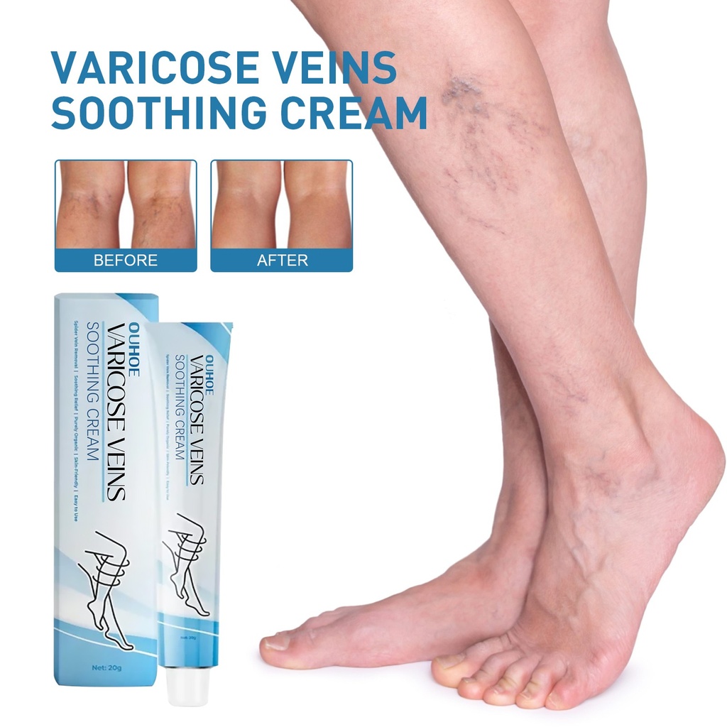 Kem Sửa Chữa Tĩnh Mạch OUHOE, Massage Giảm Đau Chân, Kem Điều Trị Varicose Veins